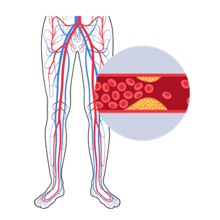 A diagram of blood vessels and blood vessels with close up view of an narrowed artery